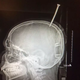X-ray of Darius Foreman’s brain (the Johns Hopkins Hospital)